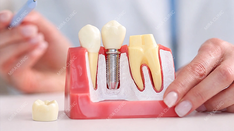 Crown for a Back Tooth
